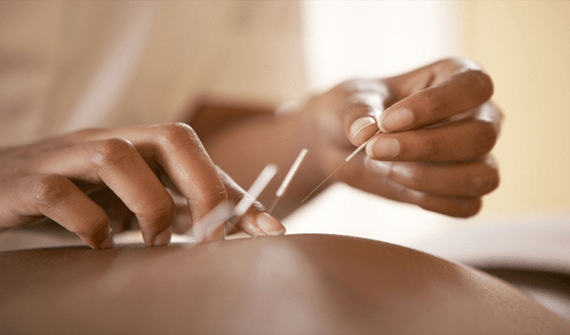 Acupuncture Can Help You Set Yourself Up for Success