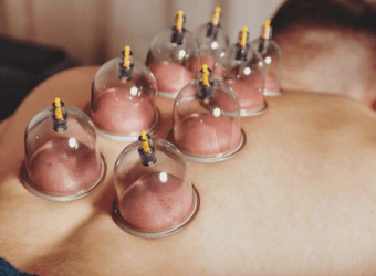 The Benefits of Cupping Therapy