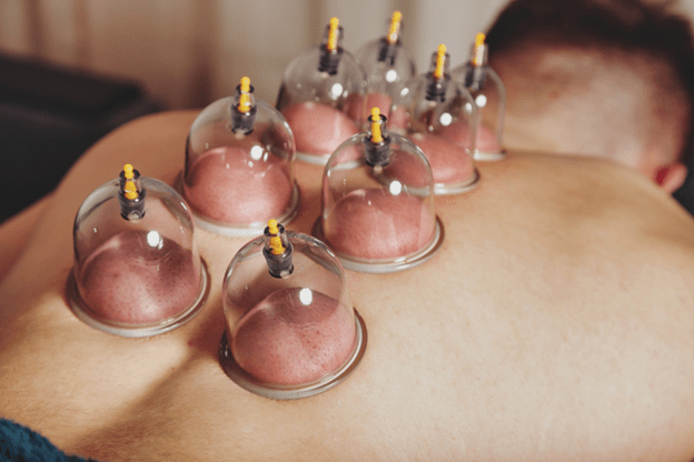 The Benefits of Cupping Therapy