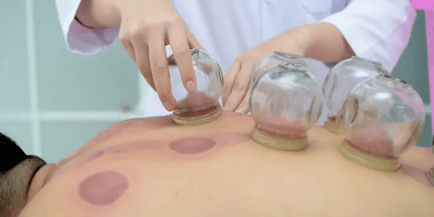The Benefits of Cupping Therapy