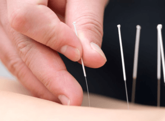 History of Acupuncture treatment and effectivity on physical well-being