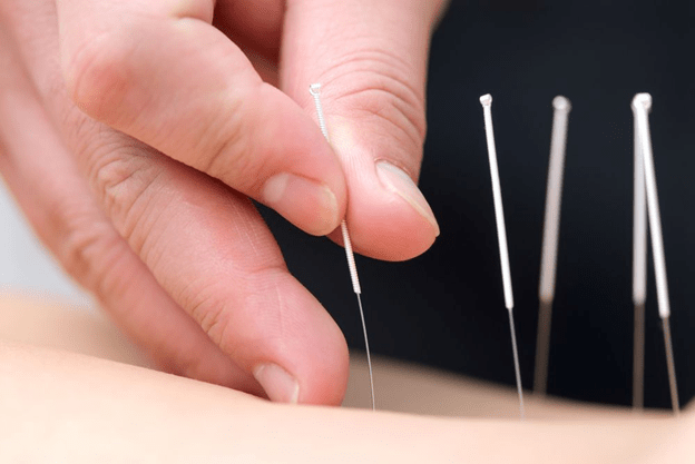 History of Acupuncture treatment and effectivity on physical well-being
