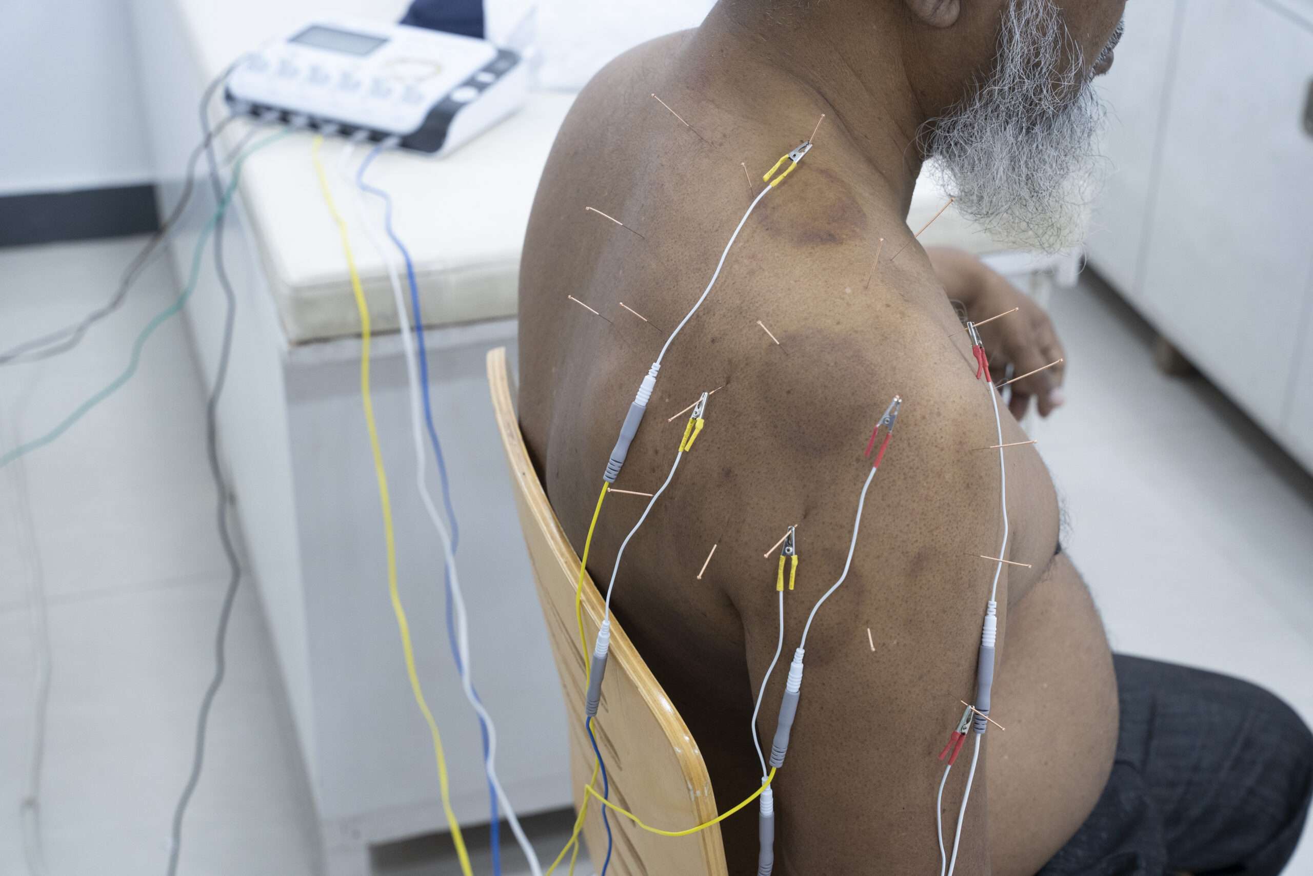 Acupuncture treatment for 27 Diseases | Electronic Acupuncture