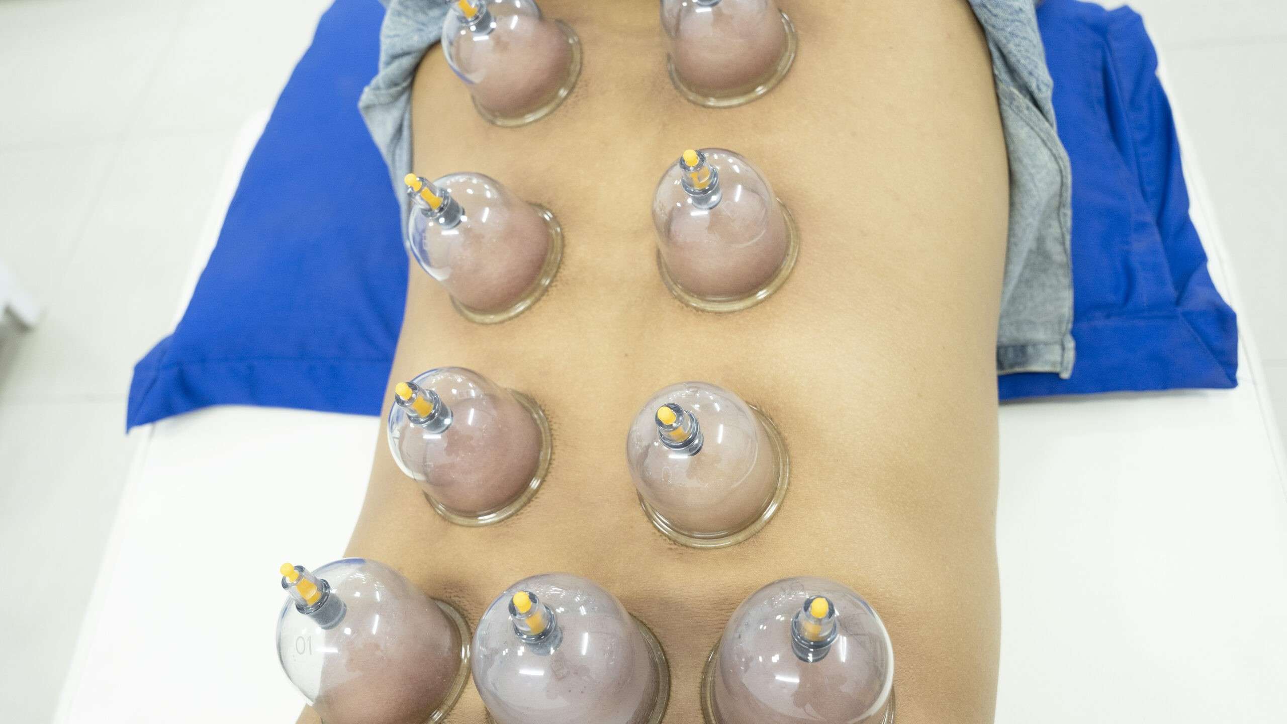 Acupuncture treatment for 27 Diseases | Hijama Cupping
