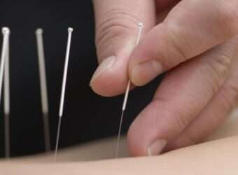 Benefits of Acupuncture in Modern Medicine