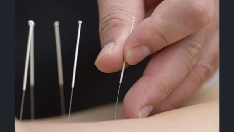 Benefits of Acupuncture in Modern Medicine