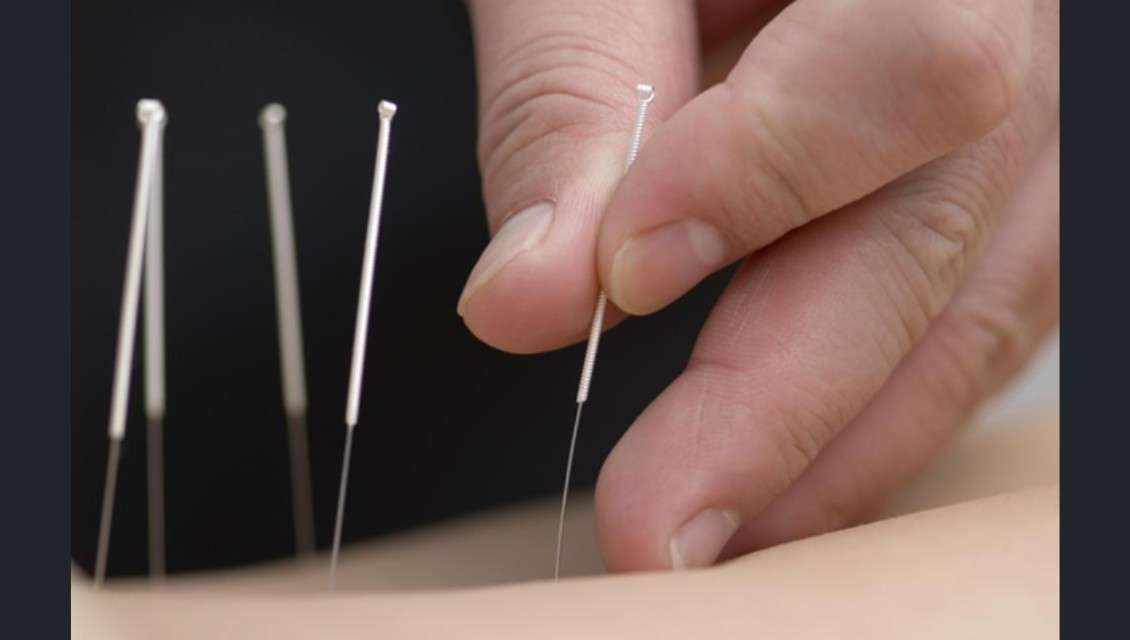 Benefits of Acupuncture in Modern Medicine