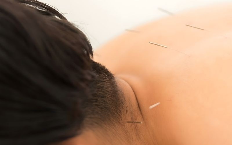 Acupuncture Treatment on Neck