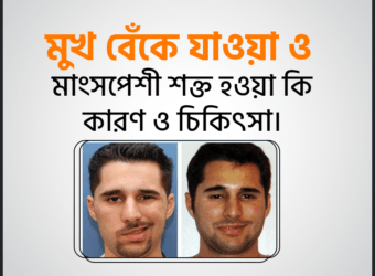 মুখ বেঁকে যাওয়া ও মাংসপেশী শক্ত হওয়া (Facial spasm) কারণ, লক্ষণ এবং আকুপাংচার চিকিৎসা