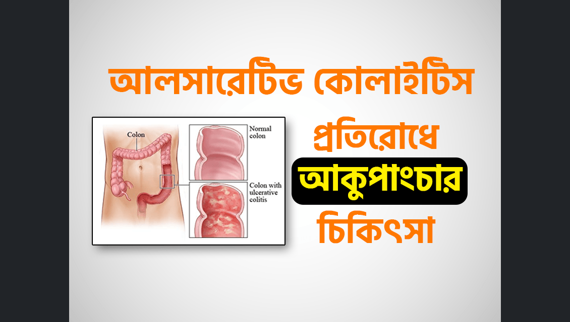 আলসারেটিভ কোলাইটিস কেন হয় ও মুক্তির উপায় | Ulcerative Colitis