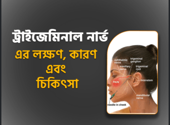 ট্রাইজেমিনাল নিউরালজিয়া রোগ কি? কারণ এবং চিকিৎসা