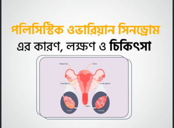 পলিসিস্টিক ওভারিয়ান সিনড্রোম