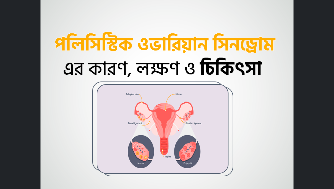 পলিসিস্টিক ওভারিয়ান সিনড্রোম