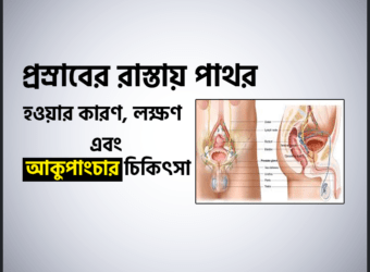 মূত্র পাথরি (Urinary Stones) হওয়ার কারণ, লক্ষণ এবং চিকিৎসা