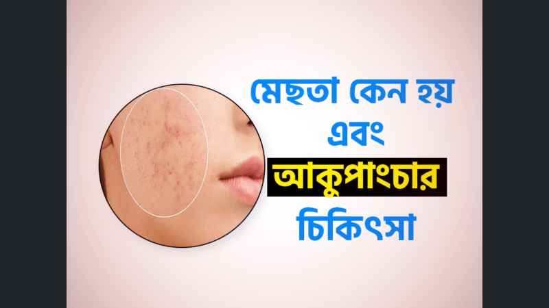 জেনে নিন মেছতা দূর করার উপায় কোন ঔষধ ছাড়া | Melasma