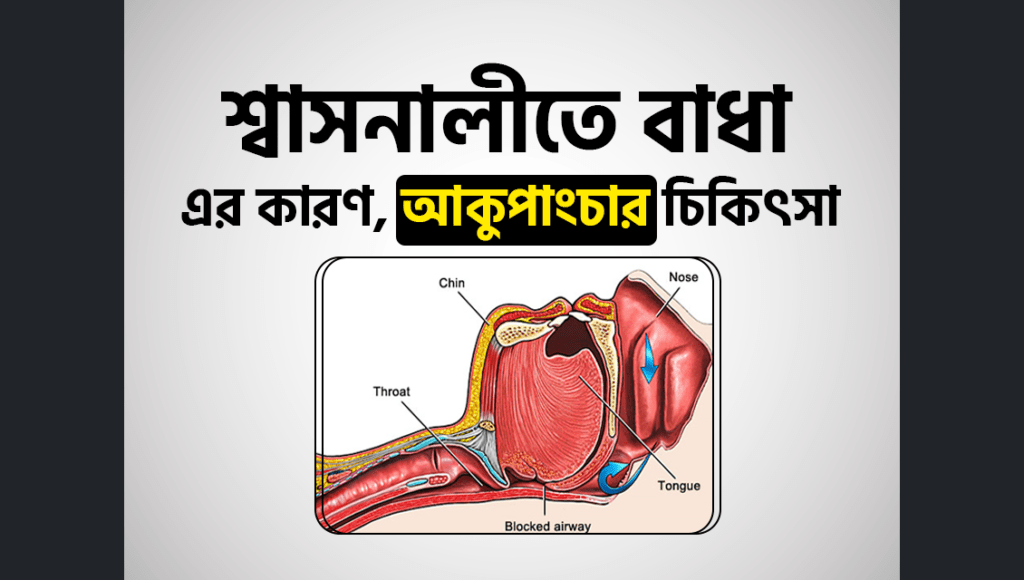 শ্বাসনালীতে বাধা এর কারণ, আকুপাংচার চিকিৎসা | Airways Obstruction