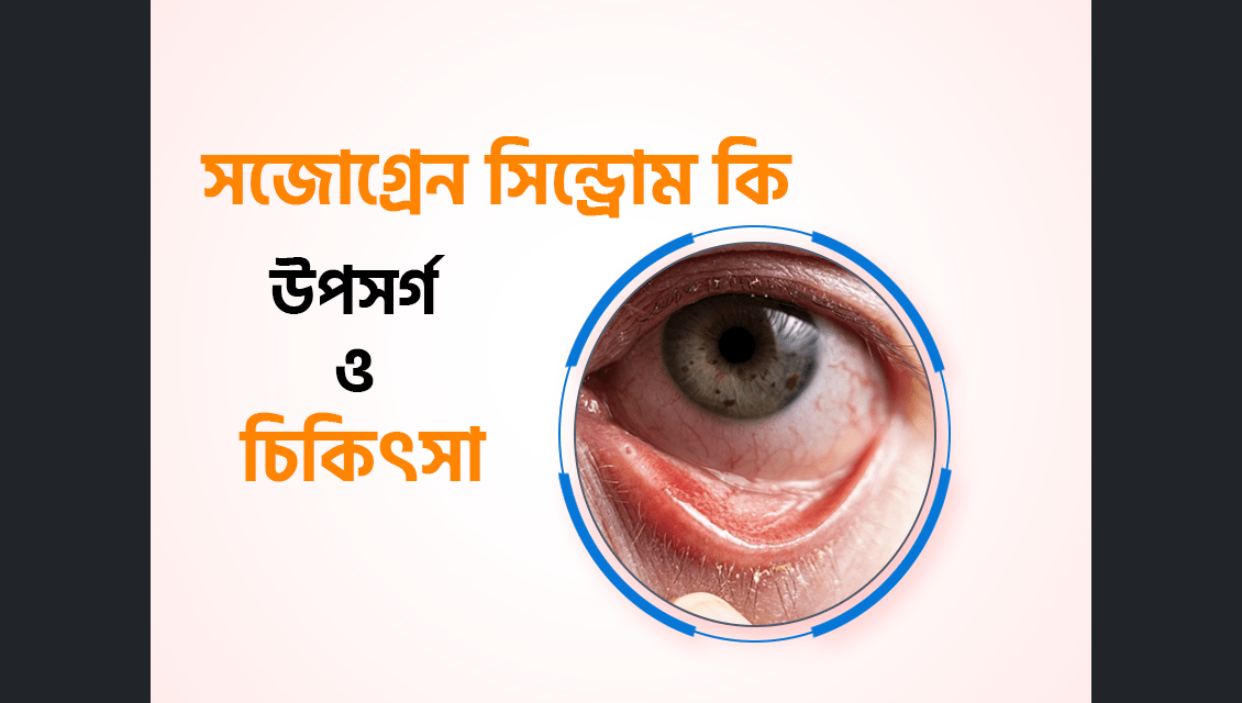 সজোগ্রেন