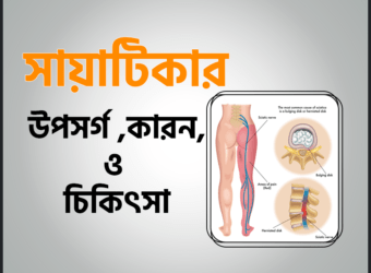 সায়াটিকার
