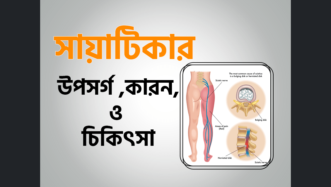 সায়াটিকার