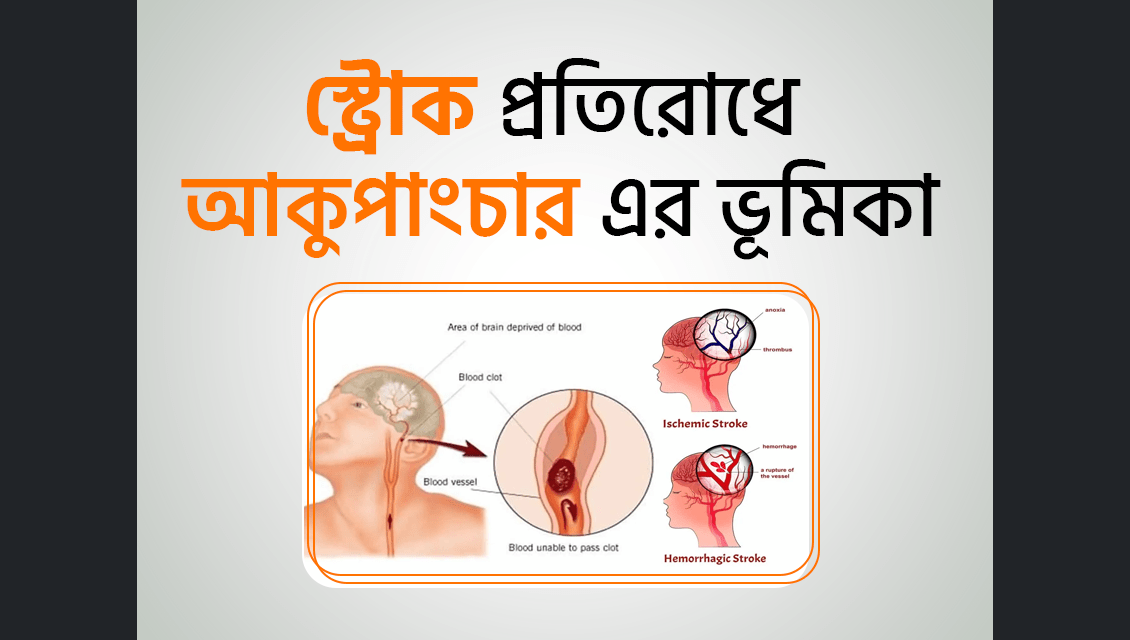 স্ট্রোক