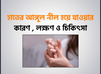 হাতের আঙ্গুল নীল হয়ে যাওয়ার (Raynaud Syndrome) কারণ , লক্ষণ এবং আকুপাংচার চিকিৎসা