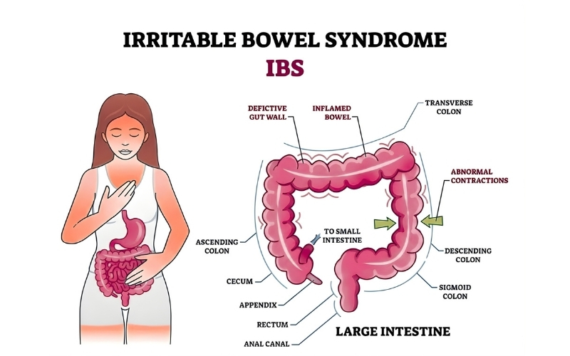 Symptoms of IBS
