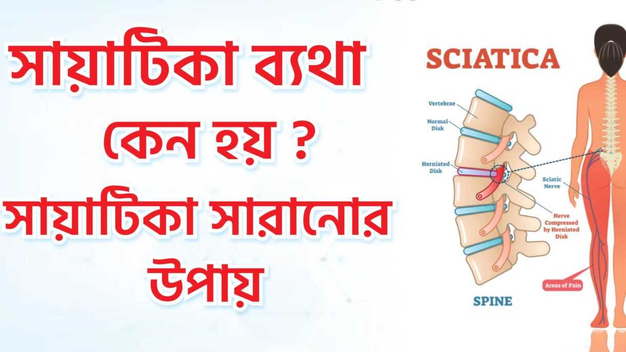 সায়াটিকা ব্যথা কেন হয়? সায়াটিকা সারানোর উপায়।