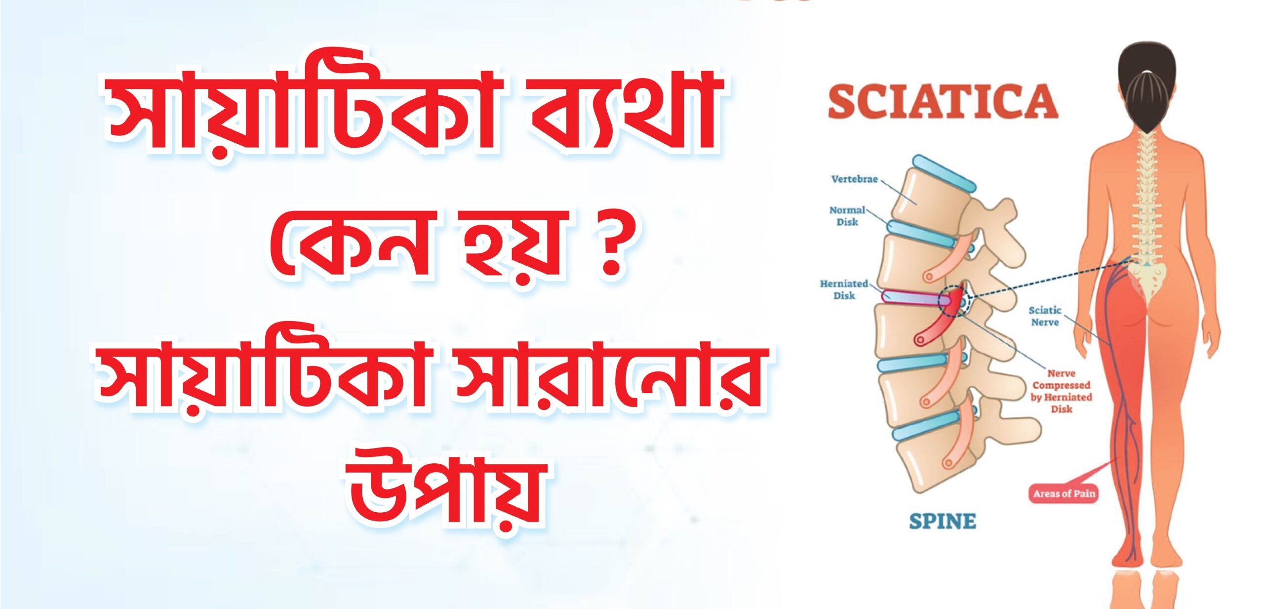 সায়াটিকা ব্যথা কেন হয়? সায়াটিকা সারানোর উপায়।